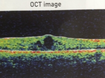 OCT image